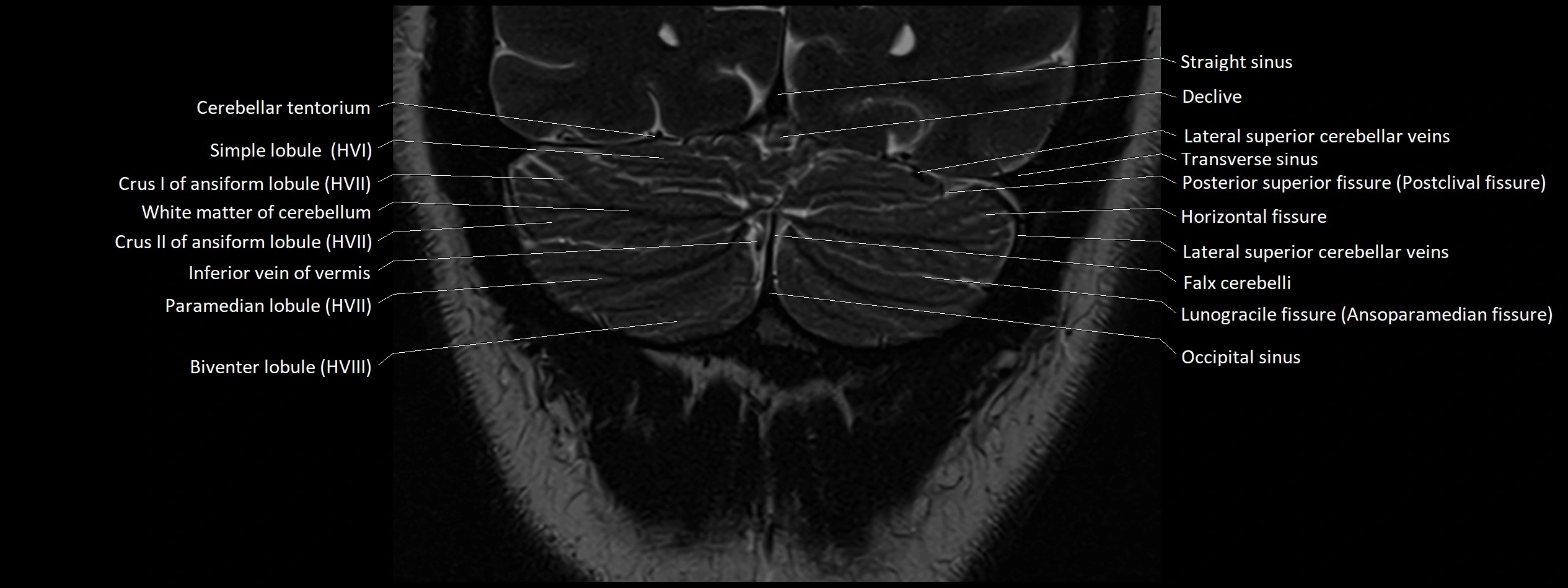 Anatomy of cerebellum coronal cross sectional 3T image 26.webp